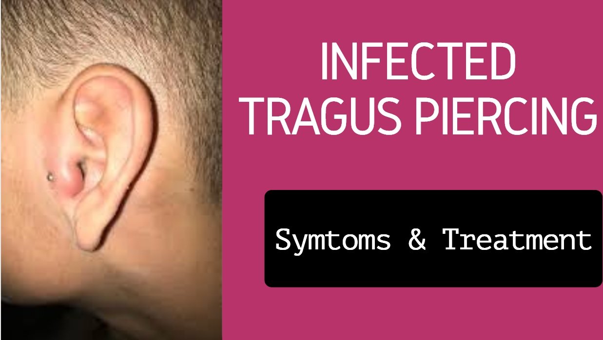 Infected Tragus Piercing